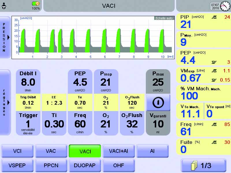 تنظیمات دستگاه ونتیلاتور